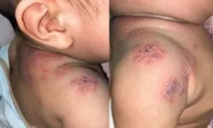 'Bệnh người già' ở trẻ em