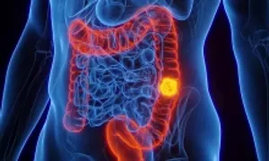 Phát hiện hai loại ung thư từ triệu chứng đau bụng